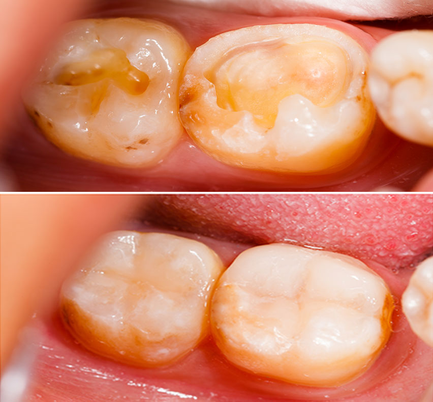 mercury and teeth fillings